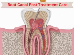 a diagram of a tooth with a root canal