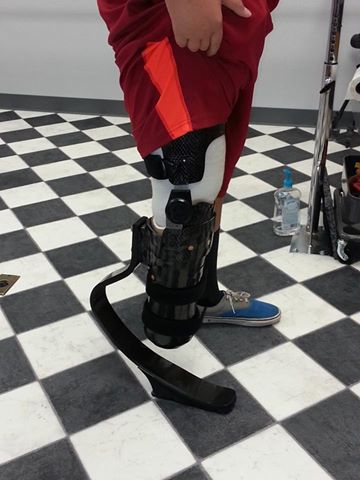 a person with a prosthetic leg