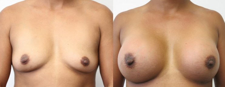 a woman's breast before and after