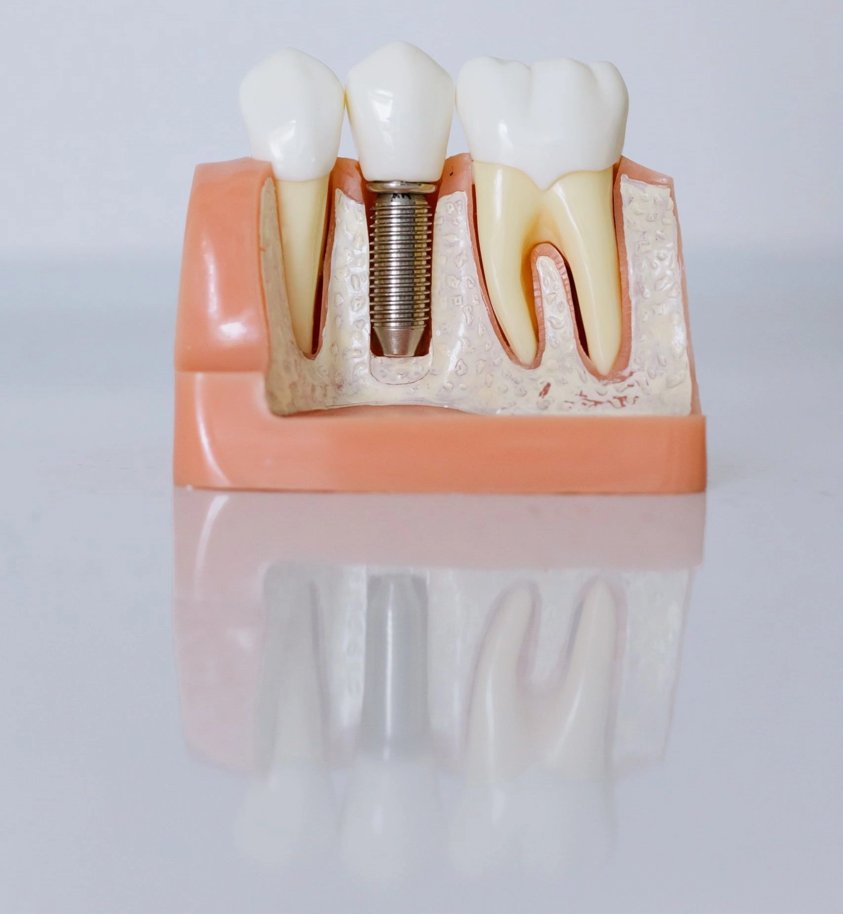 a model of teeth with a dental implant