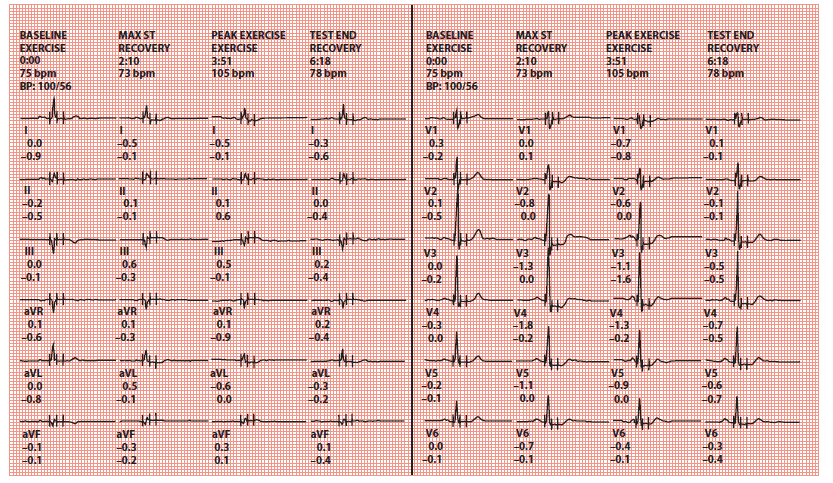 a graph of a heart rate