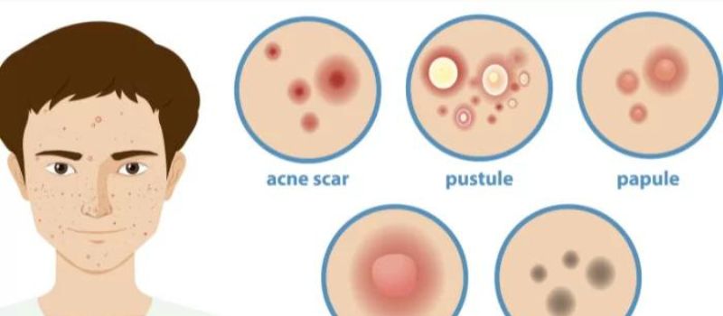 a diagram of acne skin problems