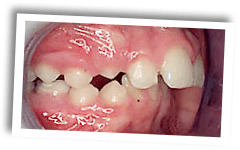 close-up of a person's mouth with broken teeth