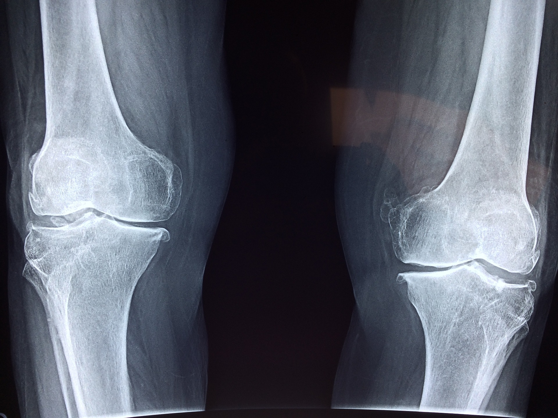 x-ray of a person's knee