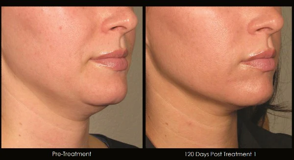 a woman's neck before and after treatment