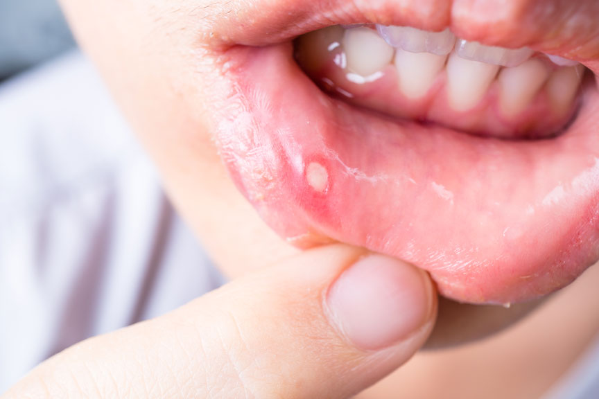 a person with sores on their lips