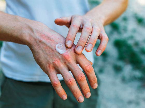 a person applying cream on their hands